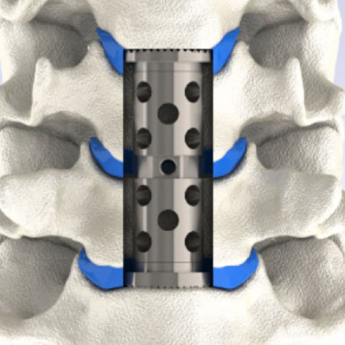 Protesi per corpectomia vertebrale cervicale - LEANDER® - HumanTech Dental - estensibile