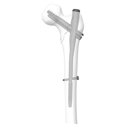 Chiodo intramidollare per femore - 305030 series - Boneunion Medical - fissazione prossimale / destro / sinistro