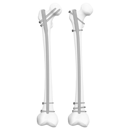 Chiodo intramidollare per femore - 305009  - Boneunion Medical - fissazione prossimale / fissazione distale / destro