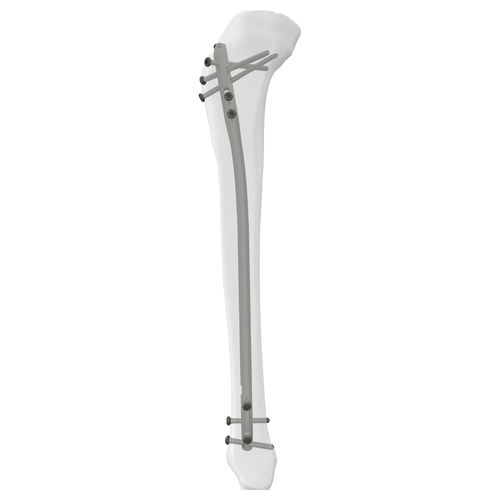 Chiodo intramidollare per tibia - 305014 series - Boneunion Medical - fissazione prossimale / fissazione distale / destro