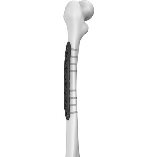 Placca di compressione per femore - 301027 series - Boneunion Medical - mediale / bloccata / in titanio