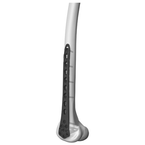 Placca di compressione per femore - 301014 series - Boneunion Medical - distale / laterale / bloccata