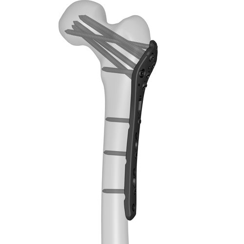 Placca di compressione femorale - 301040 series - Boneunion Medical - prossimale / bloccata / in titanio