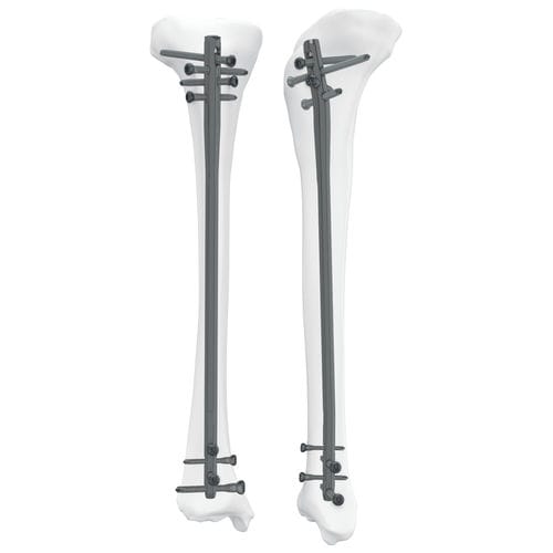 Chiodo intramidollare per tibia - 305050 series - Boneunion Medical - fissazione prossimale / fissazione distale / destro