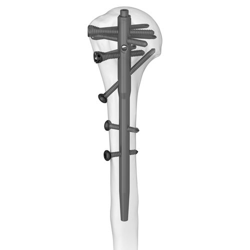 Chiodo intramidollare per omero - 305077 series - Boneunion Medical - fissazione prossimale / fissazione distale / destro