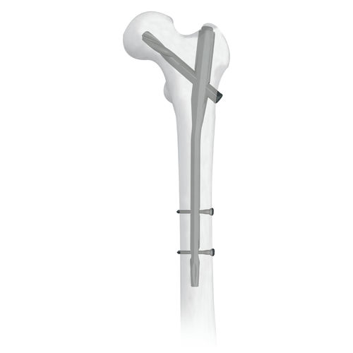 Chiodo intramidollare per femore - 30500 series - Boneunion Medical - fissazione prossimale / in titanio
