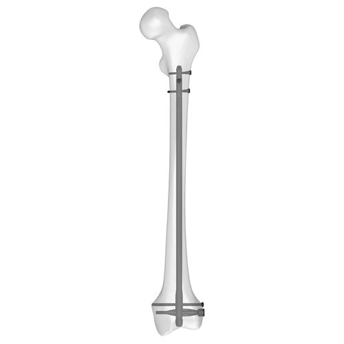 Chiodo intramidollare per femore - 30510 series - Boneunion Medical - fissazione distale / destro / sinistro