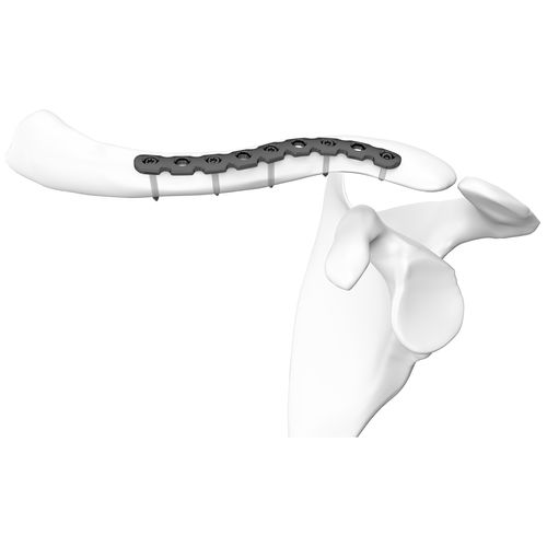 Placca di compressione per clavicola - 301249 series - Boneunion Medical - distale / bloccata / in titanio