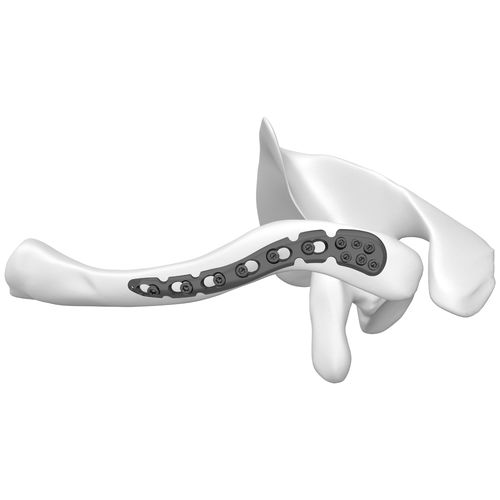 Placca di compressione per clavicola - 301055 series - Boneunion Medical - distale / bloccata / in titanio