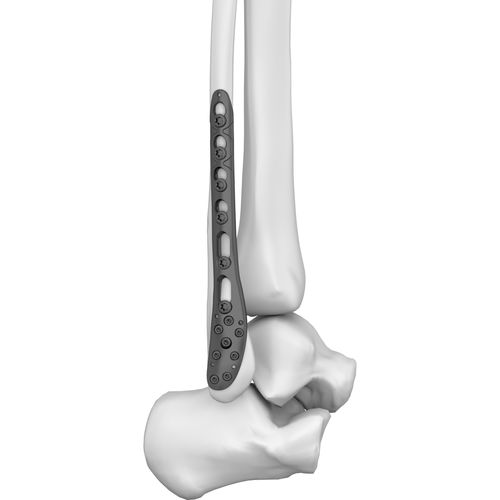 Placca di compressione per fibula - 301019 series - Boneunion Medical - distale / bloccata / in titanio