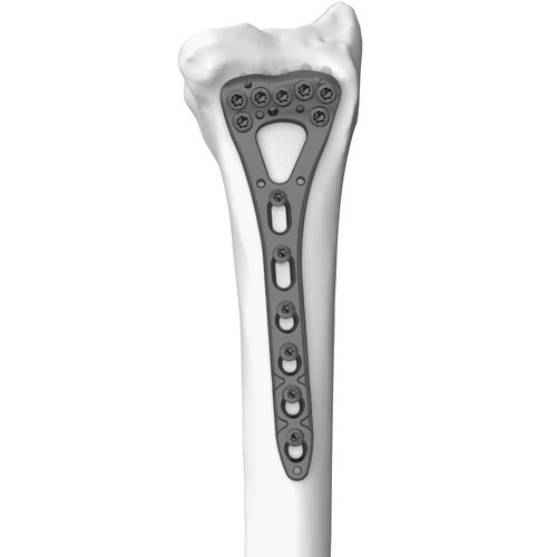 Placca di compressione per radio - 301077 series - Boneunion Medical - distale / bloccata / in titanio