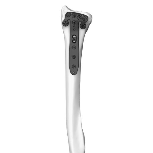Placca di compressione per radio - 30104 series - Boneunion Medical - distale / bloccata / in titanio