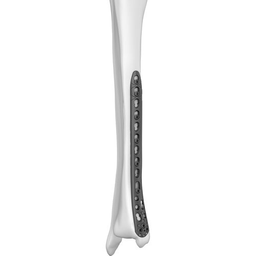Placca di compressione per tibia - 301025 series - Boneunion Medical - distale / mediale / bloccata