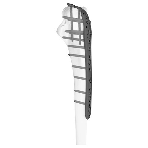 Placca di compressione per olecrano - 301043 series - Boneunion Medical - per ulna / prossimale / bloccata