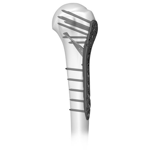 Placca di compressione per omero - 301046 series - Boneunion Medical - prossimale / bloccata / in titanio