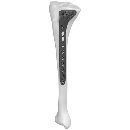 Placca di compressione per tibia - 301022 series - Boneunion Medical - prossimale / laterale / bloccata