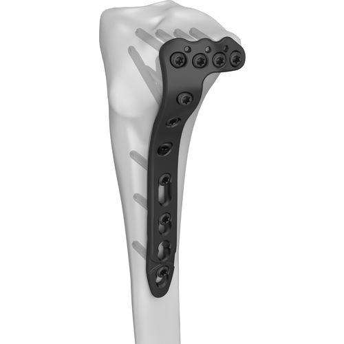 Placca di compressione per tibia - 301023 series - Boneunion Medical - prossimale / laterale / bloccata