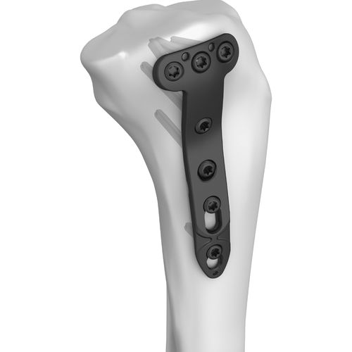 Placca di compressione per tibia - 301005 series - Boneunion Medical - prossimale / mediale / bloccata