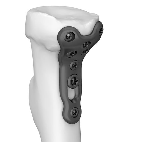 Placca di compressione per radio - 301178 series - Boneunion Medical - per capo radiale / prossimale / bloccata