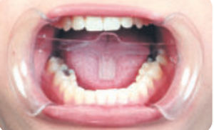 Divaricatore guancia - 2060A  - premium pluspoland - di lingua / odontoiatrico / monouso