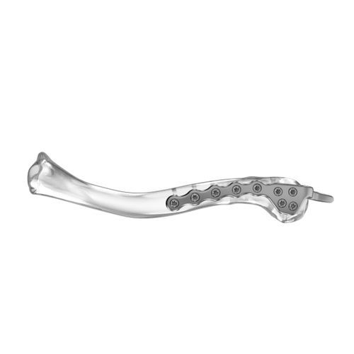Placca di compressione per clavicola - 0003 series - Aplus Biotechnology - distale / bloccata / in titanio
