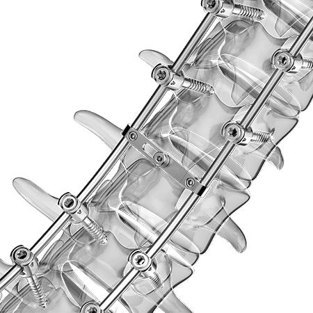 Sistema di osteosintesi toraco-lombare - Aplus Biotechnology - via posteriore / per adulti