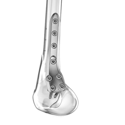 Placca per osteotomia femorale - Aplus Biotechnology - distale / bloccata / in titanio