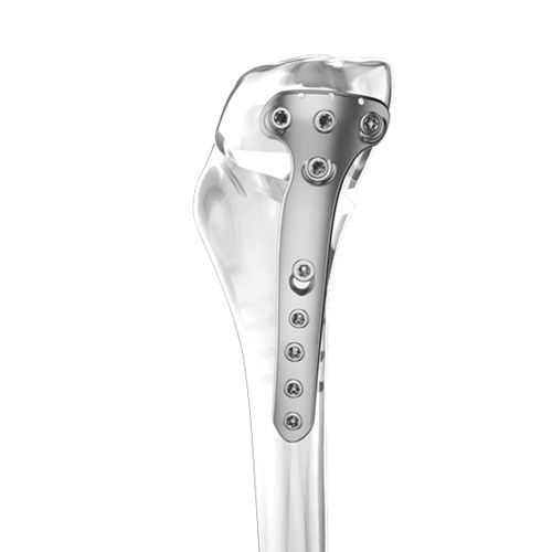 Placca per osteotomia per tibia - Aplus Biotechnology - prossimale / bloccata / in titanio