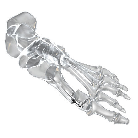 Placca per osteotomia per alluce valgo - 1600-1320-01 - Aplus Biotechnology - distale / bloccata / in titanio