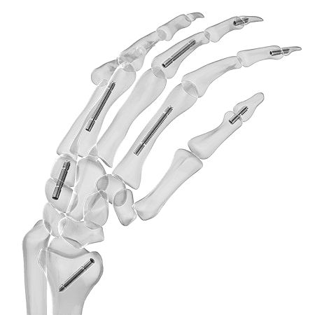 Vite per artrodesi per carpo - Aplus Biotechnology - per falange della mano / senza testa
