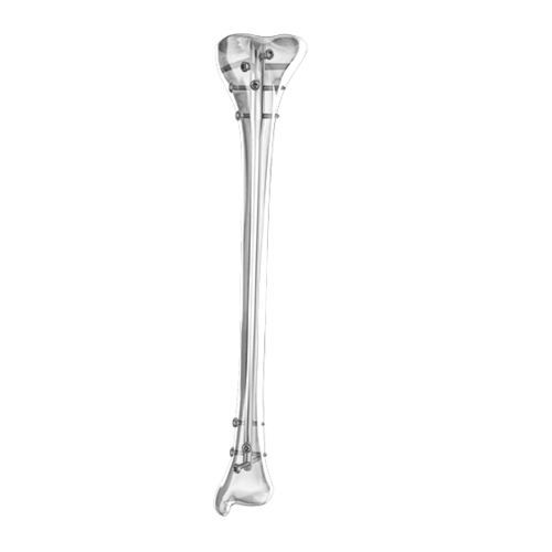 Chiodo intramidollare per tibia - Aplus Biotechnology - fissazione prossimale / fissazione distale / in metallo