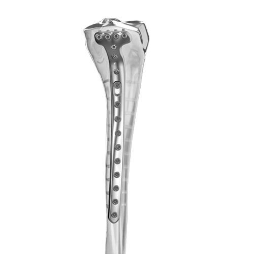 Placca di compressione per tibia - Aplus Biotechnology - prossimale / mediale / bloccata