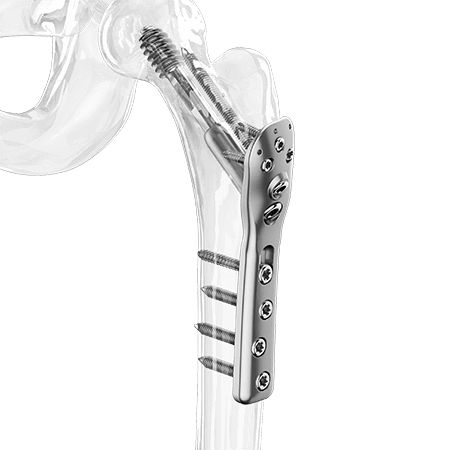 Placca di compressione per trocantere - 2500-0020:0021 series - Aplus Biotechnology - per testa del femore / prossimale / bloccata