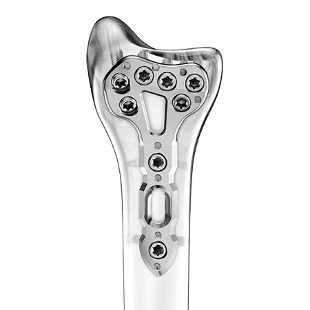 Placca di compressione per radio - Aplus Biotechnology - distale / bloccata / in titanio