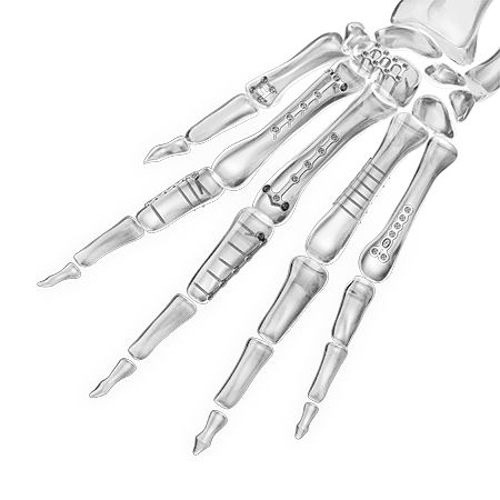 Placca di compressione per falange della mano - 1600 series - Aplus Biotechnology - per piede / per piccoli frammenti ossei / per metacarpo