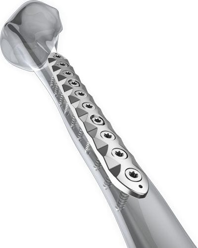 Placca di compressione per tibia - Aplus Biotechnology - mediale / bloccata / in titanio