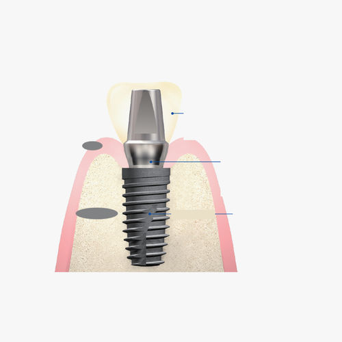 Pilastro dentale per impianto in titanio - Snucone Co.,Ltd - interno / dritto / cementato