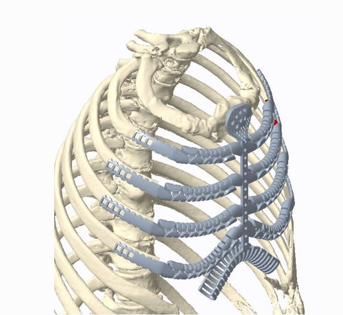 Protesi costale per ricostruzione dopo resezione di osteosarcoma - Osteobionix