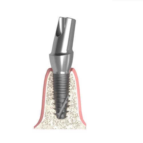 Pilastro dentale per impianto conico - UNIFORM MEGAGEN® Anyone® - Bionika Medline Kft. - in titanio / interno / angolare