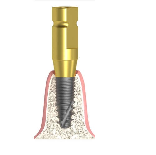 Coping di impronta in metallo - Bioplant - Bionika Medline Kft. - a vite / liscio