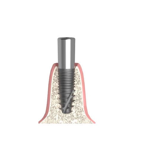 Vite di guarigione cilindrica - Actival - Bionika Medline Kft. - interna / stretta / per clinica odontoiatrica