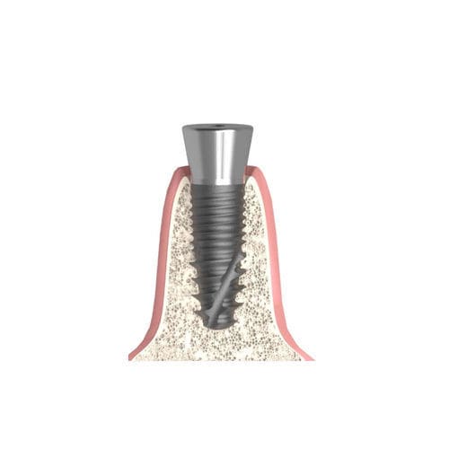 Vite di guarigione cilindrica conica - Actival - Bionika Medline Kft. - interna / a vite / per laboratorio odontotecnico