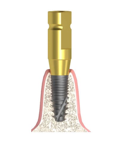 Coping di impronta in metallo - Actival - Bionika Medline Kft. - dritto / a vite / liscio