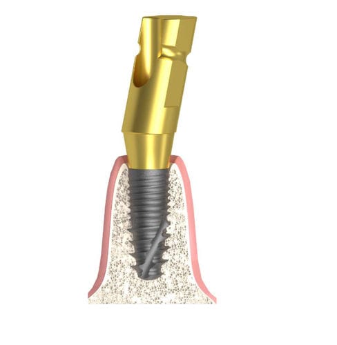 Coping di impronta in metallo - Actival - Bionika Medline Kft. - angolare / a vite / liscio