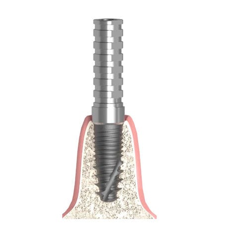 Pilastro dentale per impianto cilindrico conico - Actival - Bionika Medline Kft. - in titanio / interno / a vite