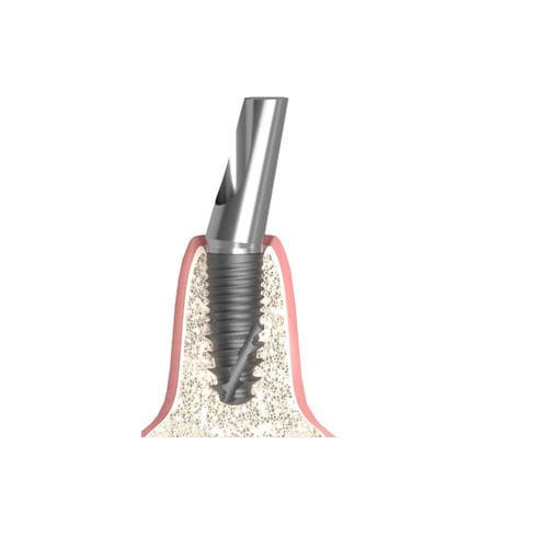 Pilastro dentale per impianto cilindrico conico - Actival - Bionika Medline Kft. - in titanio / interno / angolare