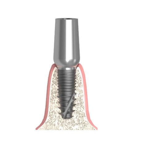 Pilastro dentale per impianto cilindrico - Actival - Bionika Medline Kft. - in titanio / interno / dritto