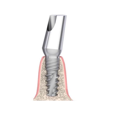 Pilastro dentale per impianto conico - Actival - Bionika Medline Kft. - in titanio / interno / angolare
