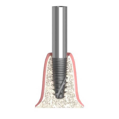 Pilastro dentale per impianto cilindrico - Actival - Bionika Medline Kft. - in titanio / interno / dritto