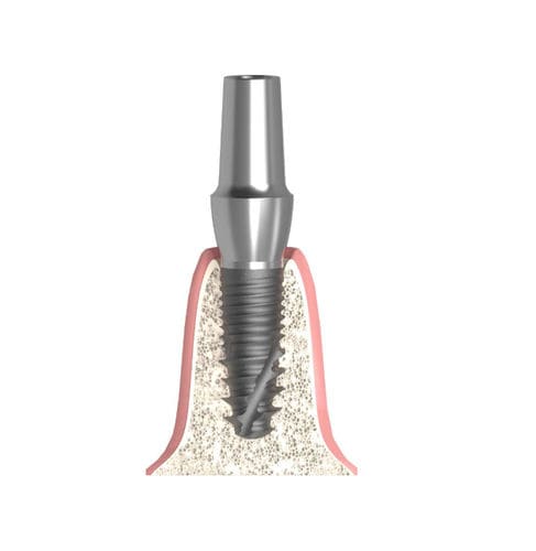 Pilastro dentale per impianto cilindrico conico - Actival - Bionika Medline Kft. - in titanio / interno / anatomico